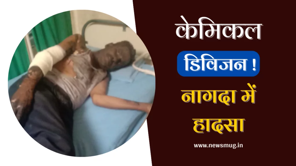 ग्रेसिम केमिकल डिविजन नागदा में आग से बुरी तरह झुलसा श्रमिक, इंदौर रैफर workers-badly-scorched-by-fire-in-grasim-chemical-division-nagda-indore-refer